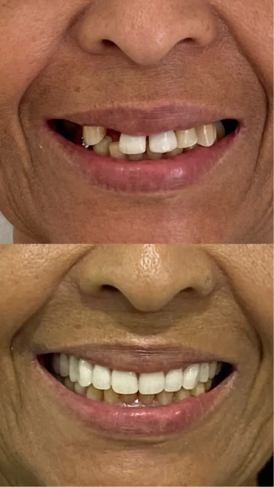 dep_antes_e_depois_1