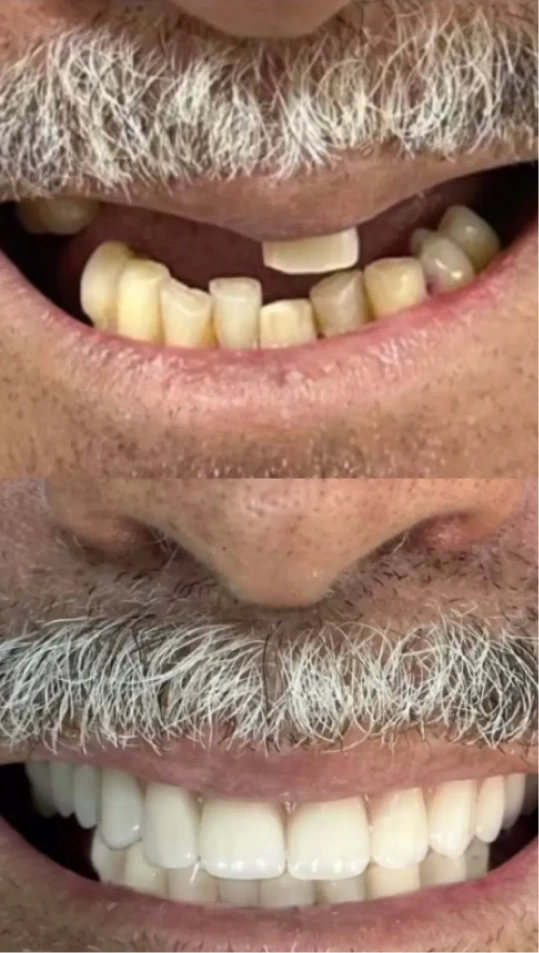 dep_antes_e_depois_2