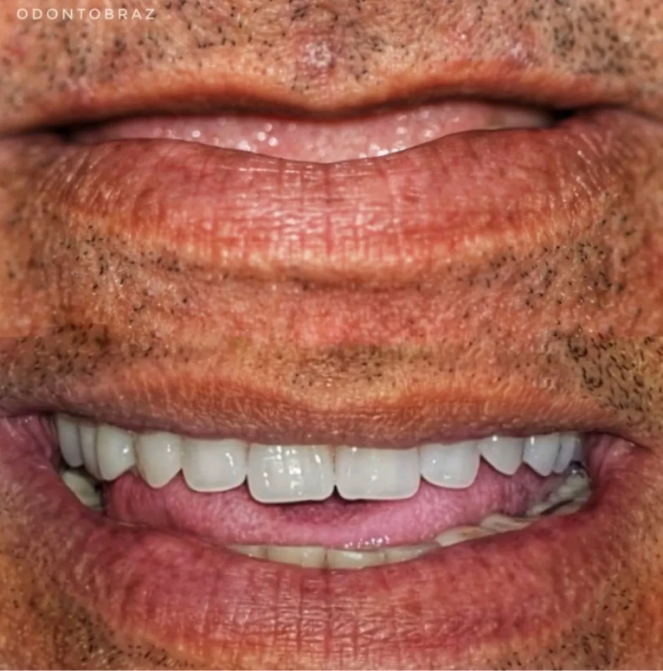 dep_antes_e_depois_3