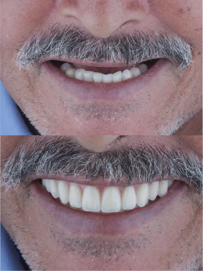 dep_antes_e_depois_5